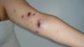 LYMPHOMAS - LYMPHOCYTIC INFILTRATIONS - Primary cutaneous CD8-positive epidermotropic cytotoxic T cell lymphoma