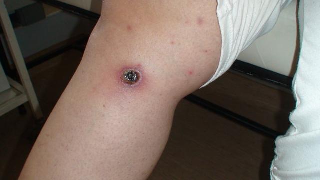 LYMPHOMAS - LYMPHOCYTIC INFILTRATIONS - Primary cutaneous CD8-positive epidermotropic cytotoxic T cell lymphoma LYMPHOMAS - LYMPHOCYTIC INFILTRATIONS - Primary cutaneous CD8-positive epidermotropic cytotoxic T cell lymphoma