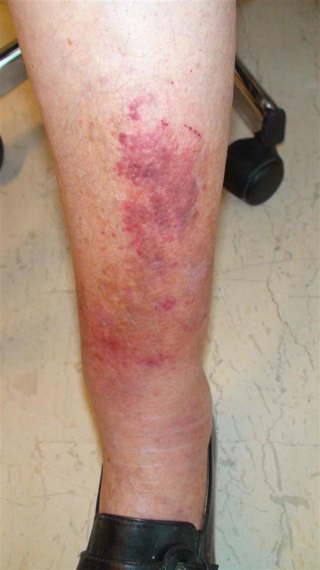 BACTERIAL INFECTIONS - Erysipelas BACTERIAL INFECTIONS - Erysipelas