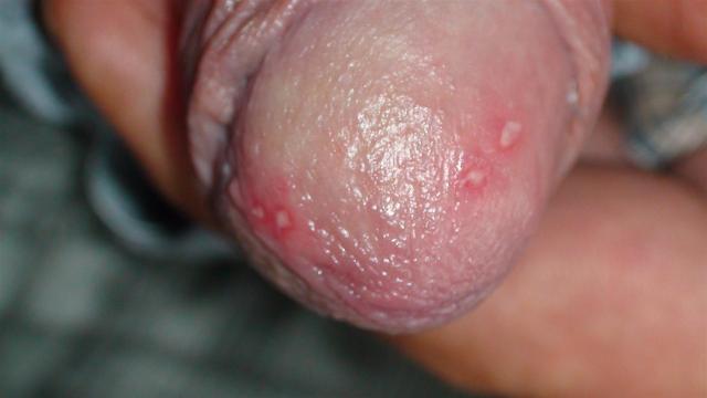 VIRAL INFECTIONS - Herpes Simplex VIRAL INFECTIONS - Herpes Simplex