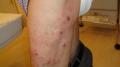 VIRAL INFECTIONS - Herpes Zoster