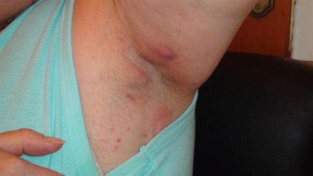 DISEASES OF THE SEBACEOUS GLANDS - Hidradenitis Suppurativa DISEASES OF THE SEBACEOUS GLANDS - Hidradenitis Suppurativa