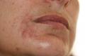 DISEASES OF THE SEBACEOUS GLANDS - Perioral Dermatitis