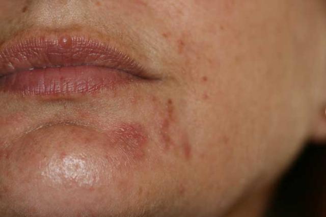 DISEASES OF THE SEBACEOUS GLANDS - Perioral Dermatitis