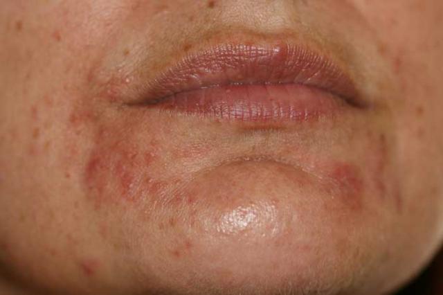 DISEASES OF THE SEBACEOUS GLANDS - Perioral Dermatitis