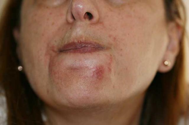 DISEASES OF THE SEBACEOUS GLANDS - Perioral Dermatitis