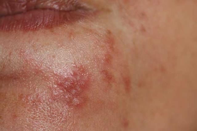 DISEASES OF THE SEBACEOUS GLANDS - Perioral Dermatitis