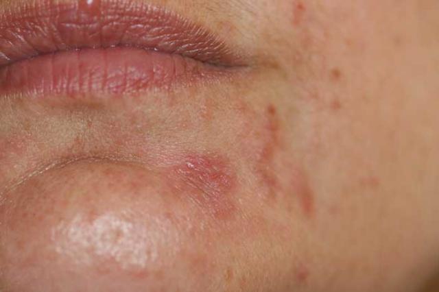 DISEASES OF THE SEBACEOUS GLANDS - Perioral Dermatitis