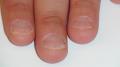 NAIL DISEASES - Onychotillomania