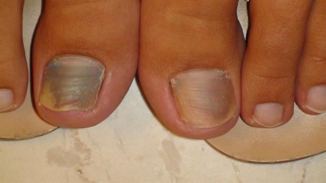 NAIL DISEASES - Onychomycosis NAIL DISEASES - Onychomycosis