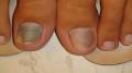 NAIL DISEASES - Onychomycosis