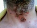 BACTERIAL INFECTIONS - Impetigo