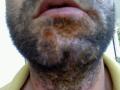 BACTERIAL INFECTIONS - Impetigo