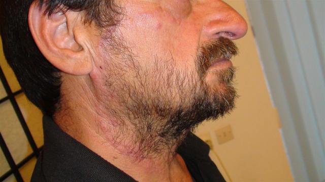 SUPERFICIAL FUNGAL INFECTIONS - Tinea faciale SUPERFICIAL FUNGAL INFECTIONS - Tinea faciale