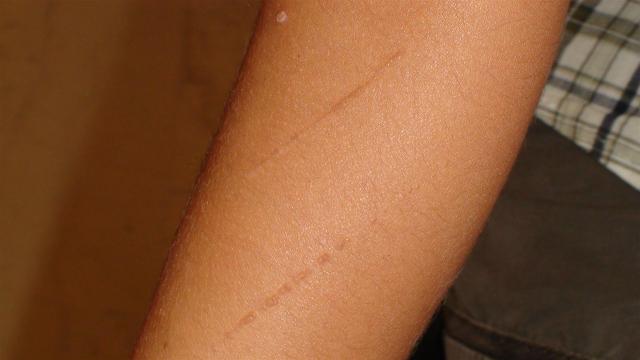 VIRAL INFECTIONS - Warts VIRAL INFECTIONS - Warts