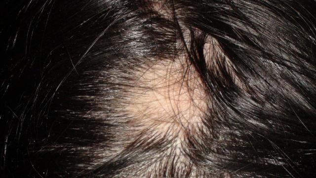 HAIR DISEASES - Alopecia Areata HAIR DISEASES - Alopecia Areata