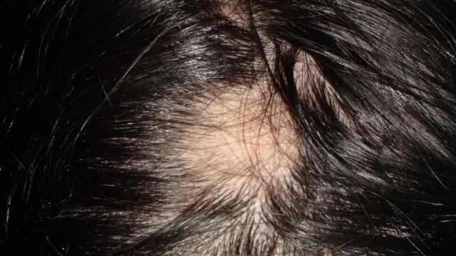 HAIR DISEASES - Alopecia Areata