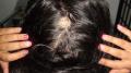 HAIR DISEASES - Alopecia Areata