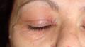 DERMATITIS - EKZEMA - Dermatitis of the eyelids