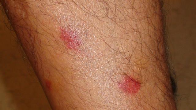 PARASITOSES, BITES - Flea bites PARASITOSES, BITES - Flea bites