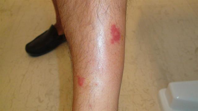 PARASITOSES, BITES - Flea bites PARASITOSES, BITES - Flea bites