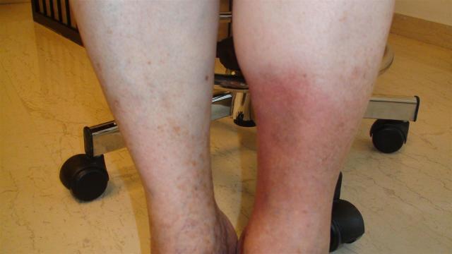 DISEASE OF THE BLOOD AND THE VESSELS – PURPURAS - Lipodermatosclerosis DISEASE OF THE BLOOD AND THE VESSELS – PURPURAS - Lipodermatosclerosis