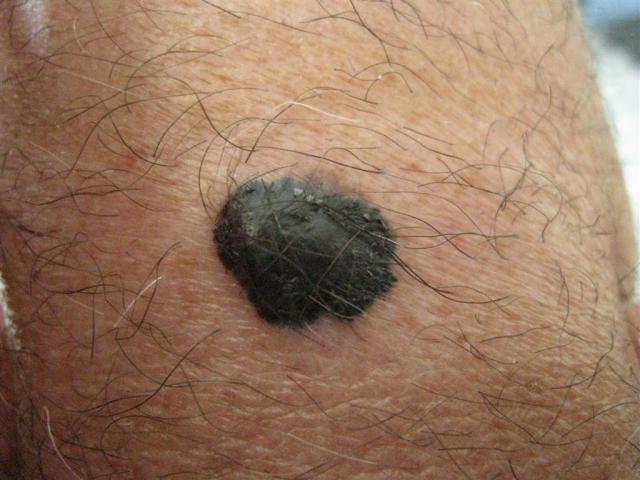 MALIGNANT LESIONS - Melanomas