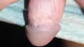 MUCOSAL LESIONS - Pearly penile Papules