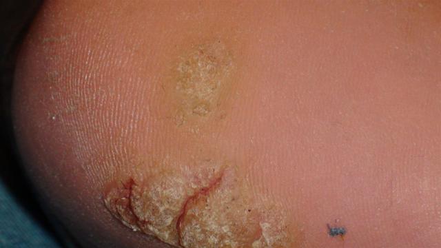 VIRAL INFECTIONS - Warts