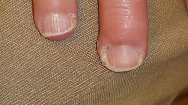 VIRAL INFECTIONS - Warts VIRAL INFECTIONS - Warts