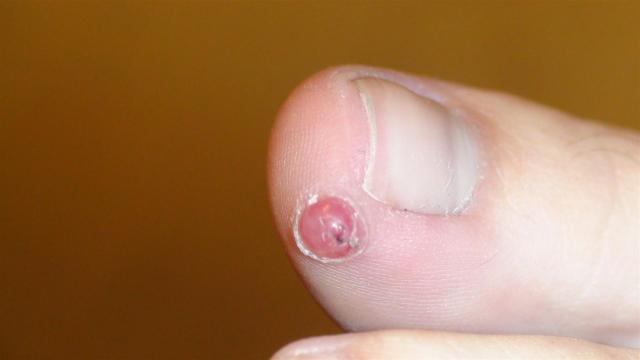 DISEASE OF THE BLOOD AND THE VESSELS – PURPURAS - Pyogenic granuloma