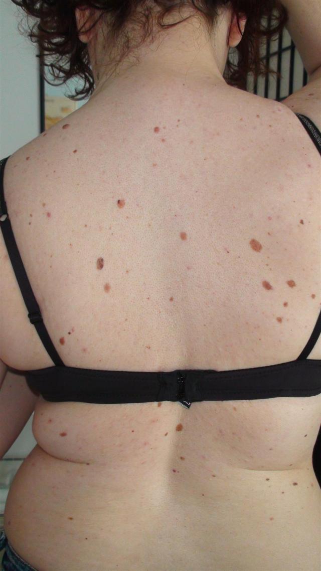 BENIGN SKIN LESIONS, NEVI, CYSTS - Dysplastic Nevus syndrome