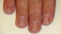 PSORIASIS - Psoriatic nails