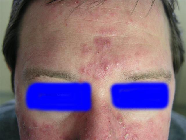 DISEASES OF THE SEBACEOUS GLANDS - Acne, Cystic