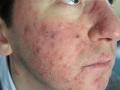 DISEASES OF THE SEBACEOUS GLANDS - Acne, Cystic