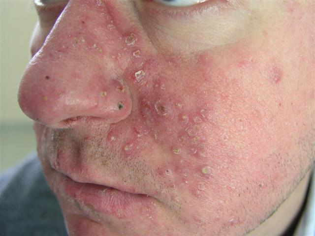 DISEASES OF THE SEBACEOUS GLANDS - Acne, Cystic