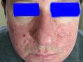 DISEASES OF THE SEBACEOUS GLANDS - Acne, Cystic