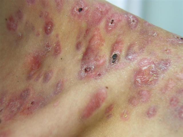 DISEASES OF THE SEBACEOUS GLANDS - Necrotic Acne