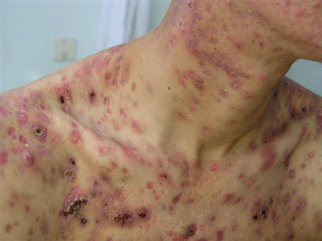 DISEASES OF THE SEBACEOUS GLANDS - Necrotic Acne