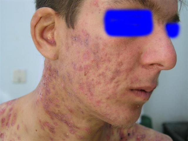 DISEASES OF THE SEBACEOUS GLANDS - Necrotic Acne