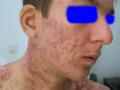 DISEASES OF THE SEBACEOUS GLANDS - Necrotic Acne