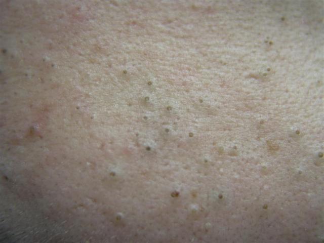 DISEASES OF THE SEBACEOUS GLANDS - Acne, Comedonal