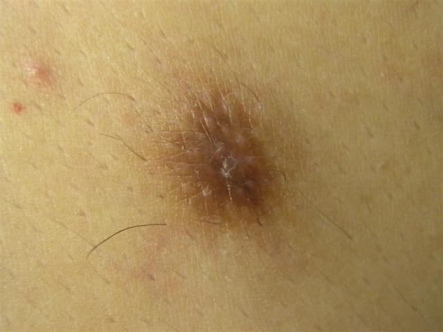 BENIGN SKIN LESIONS, NEVI, CYSTS - Dermatofibroma