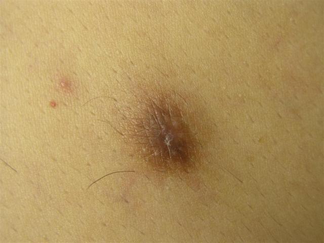 BENIGN SKIN LESIONS, NEVI, CYSTS - Dermatofibroma